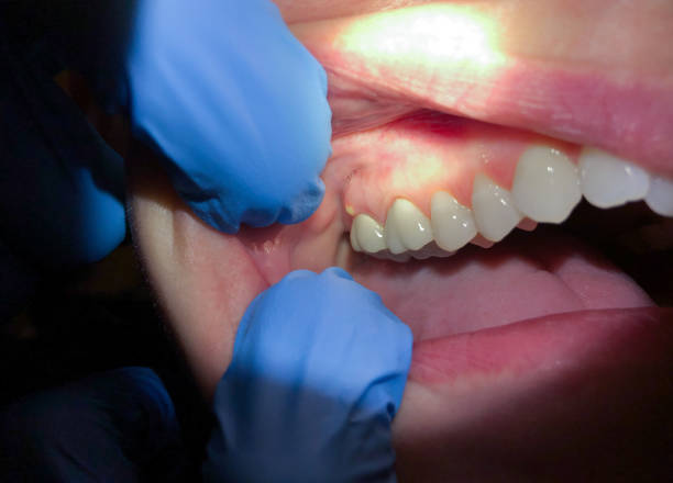 Best Emergency Denture Repair in Orient, NY