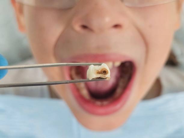 Best Emergency Treatment for Dental Infections or Abscesses in Orient, NY